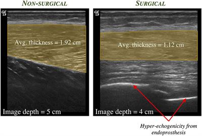 Alterations in Muscle Architecture: A Review of the Relevance to Individuals After Limb Salvage Surgery for Bone Sarcoma